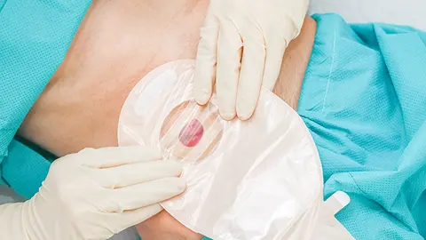 Paciente se coloca la bolsa (Foto: envato)