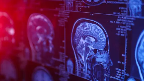 Resonancia de la cabeza y cerebro (Foto: envato)